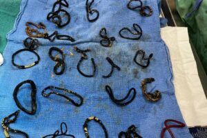Cats-intestinal-blockage-found-to-be-26-swallowed-hair-ties.jpg